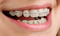 Metal vs Ceramic Braces - Zen Dental & Health care